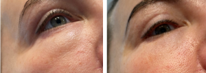 Topilase Effet Tyndall