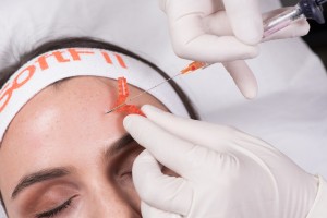 injection microcannula forehead