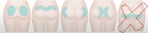 buttocks injection technique with softfil microcannula